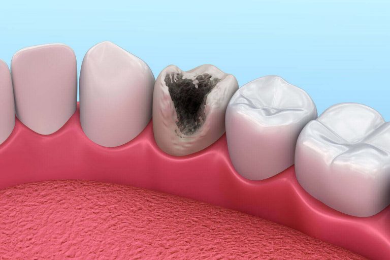 Tooth Enamel Decay And Cavity At High Risk With Erosion