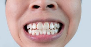 holes in teeth that aren't cavities